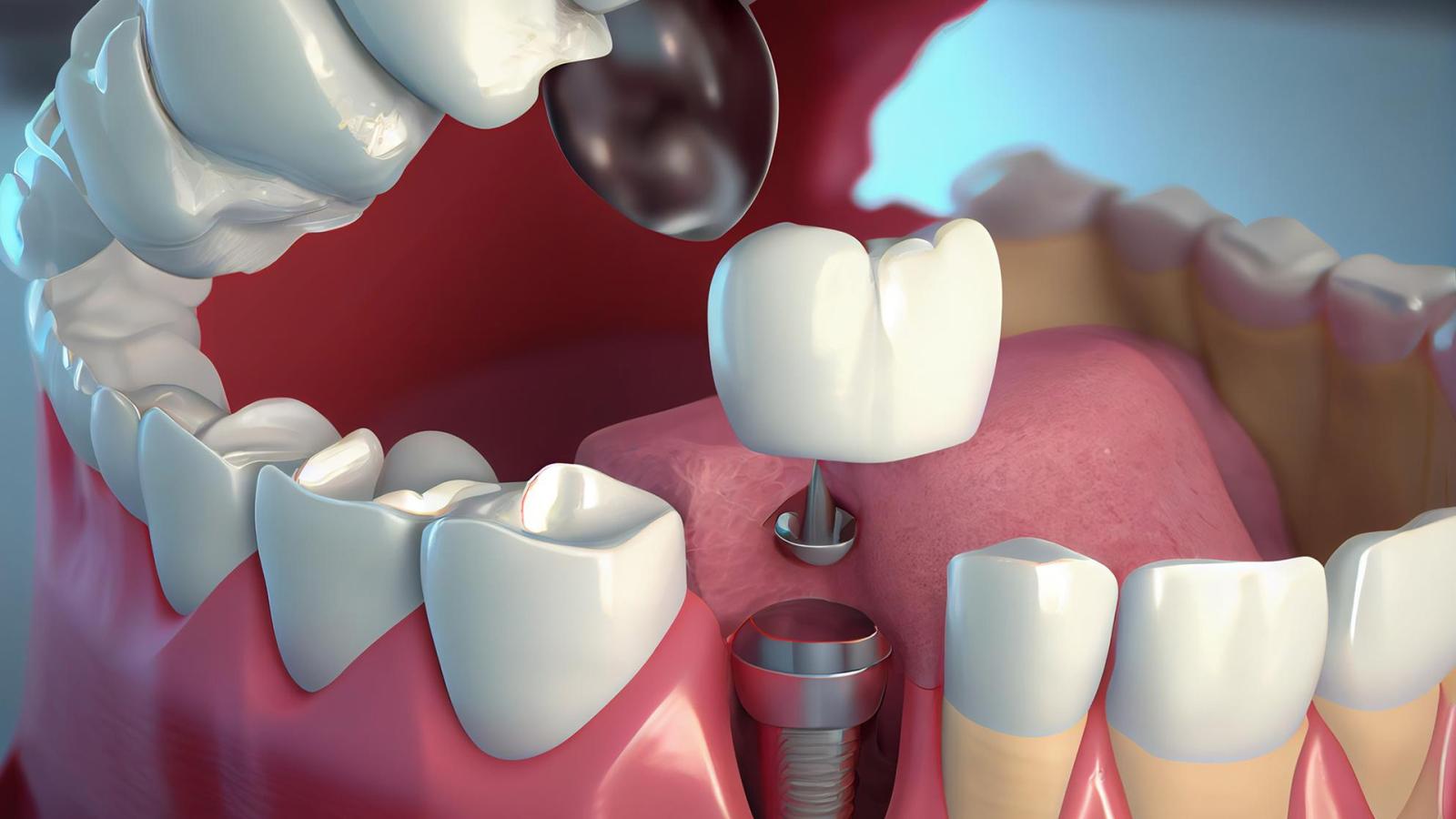 Implantes Dentales en Soria: Todo lo que necesitas saber antes de tu tratamiento