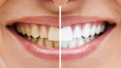 Blanqueamiento Dental en Soria: Mitos y Realidades sobre este Tratamiento